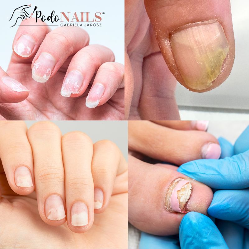 Onycholiza — co oznacza odwarstwienie paznokcia? — poradnik PodoNAILS